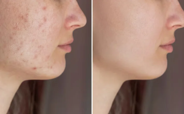 Acne Scars Treatment | Vedic Aesthetica Skin Clinic - Effective Solutions  for Clearer Skin